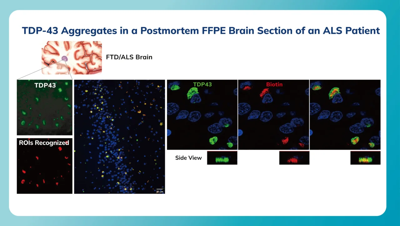 FTD-ALS aggregates (Brain) PL image